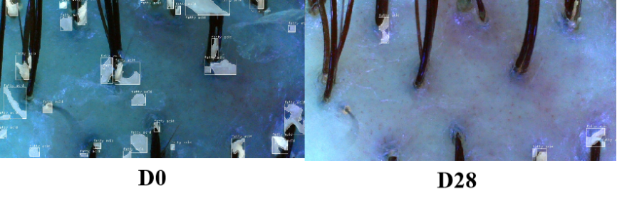 头皮,健康,头皮脱屑,头皮皮脂,CIRS,功效评价,技术实践